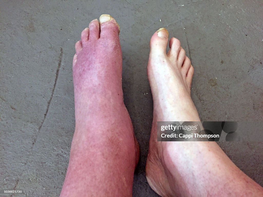 A severely swollen foot in a man from a head on car accident