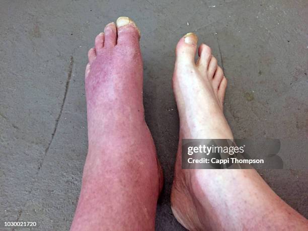 a severely swollen foot in a man from a head on car accident - swollen ankles stock pictures, royalty-free photos & images