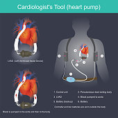 A Cardiologist's Tool (heart pump)