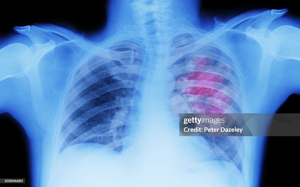 X-ray of lung showing chest cancer