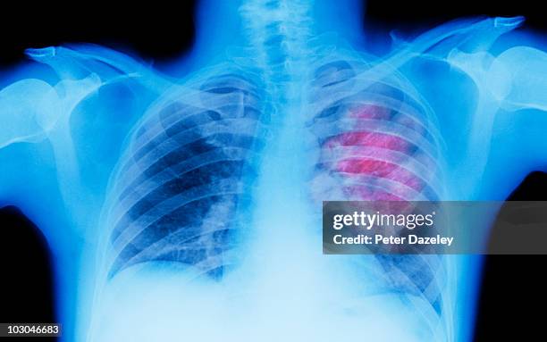 x-ray of lung showing chest cancer - lung cancer stockfoto's en -beelden