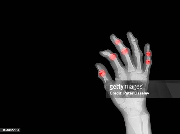 x-ray of hand showing arthritis - deformed hand stock pictures, royalty-free photos & images