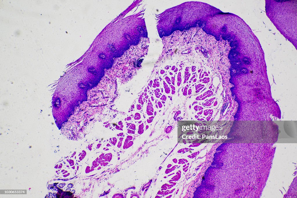 Micrograph of squamous cells carcinoma