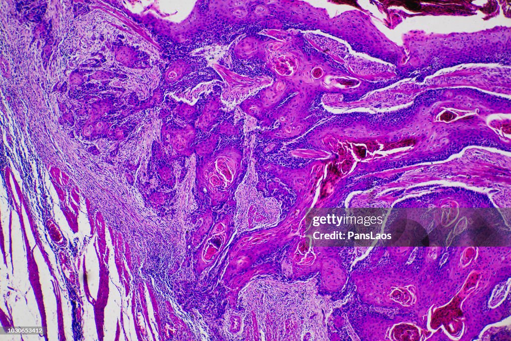 Micrograph of squamous cells carcinoma