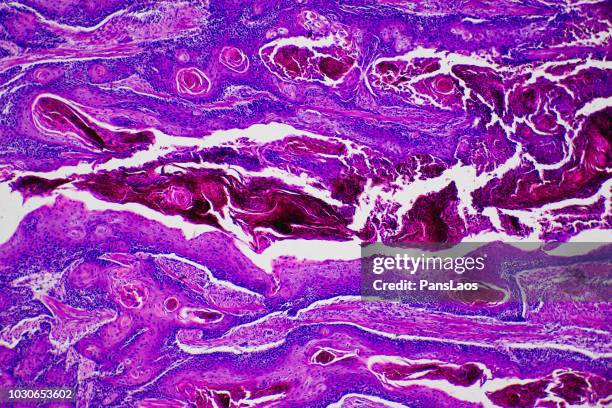 squamous cancer cell carcinoma of human - virus del papilloma umano foto e immagini stock