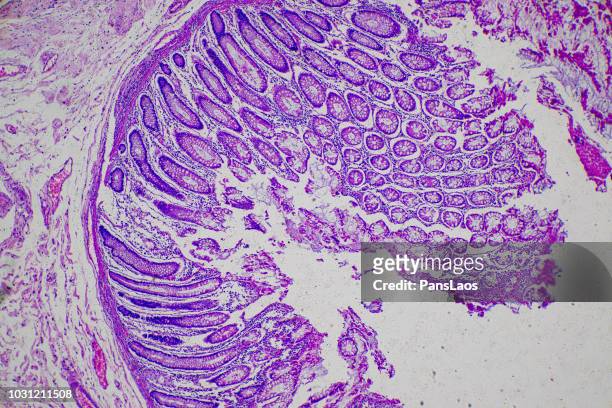 micrograph of adenocarcinoma cancer cells - biopsy - fotografias e filmes do acervo