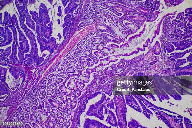 adenocarcinoma of human tumor tissue micrograph - vergrößerung stock-fotos und bilder