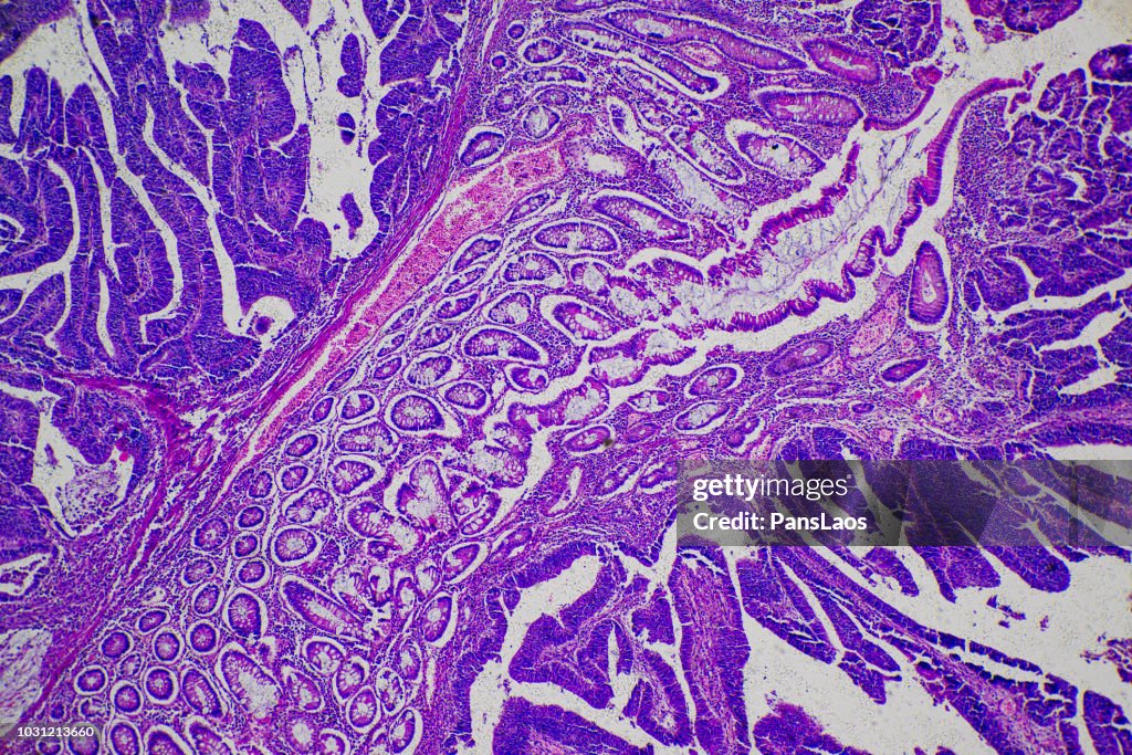 Adenocarcinoma of human tumor tissue micrograph