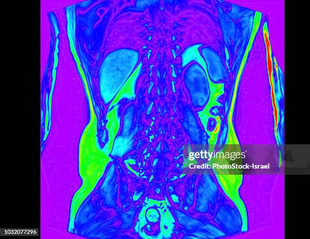 frontal abdomen mri scan of 60 year old male patient with kidney stone - mri abdomen stock pictures, royalty-free photos & images