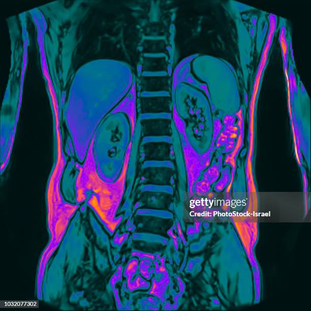 frontal abdomen mri scan of 60 year old male patient with kidney stone - male stomach stock-fotos und bilder