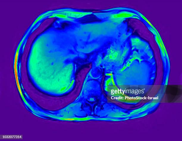 cross section abdomen mri scan of 60 year old male patient with kidney stone - mri abdomen stock pictures, royalty-free photos & images