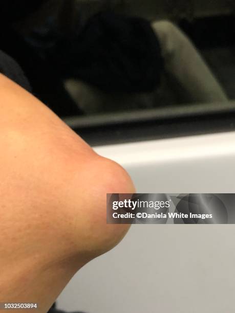 bursitis - slijmbeursontsteking stockfoto's en -beelden