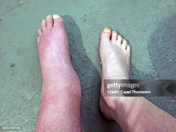 severely swollen foot- edema - swollen stock pictures, royalty-free photos & images