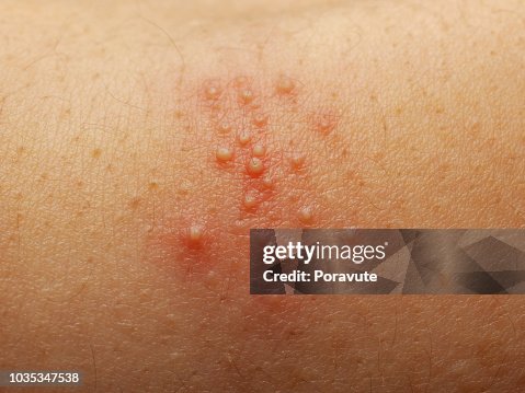 Rash And Other Nonspecific Skin Eruption High-Res Stock Photo - Getty ...