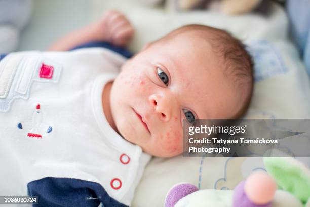 cute newborn baby boy, playing in crib, newborn acne rash on his face - baby skin fotografías e imágenes de stock