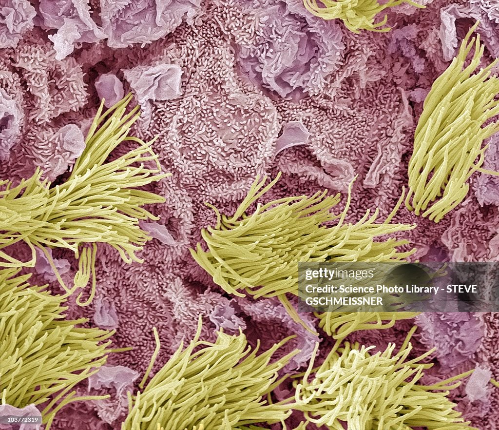 Uterine cancer, SEM