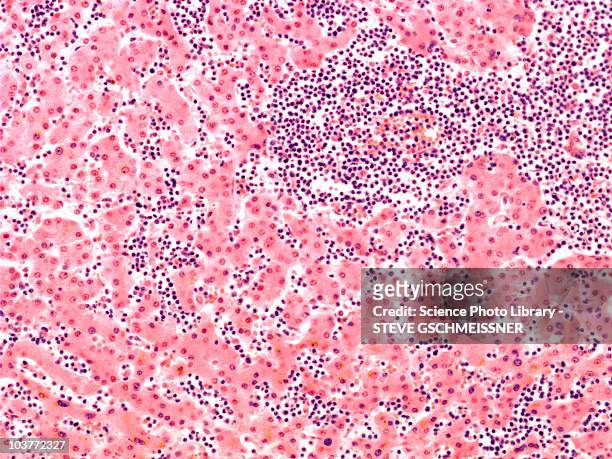 leukaemia blood cells, light micrograph - leukemia ストックフォトと画像