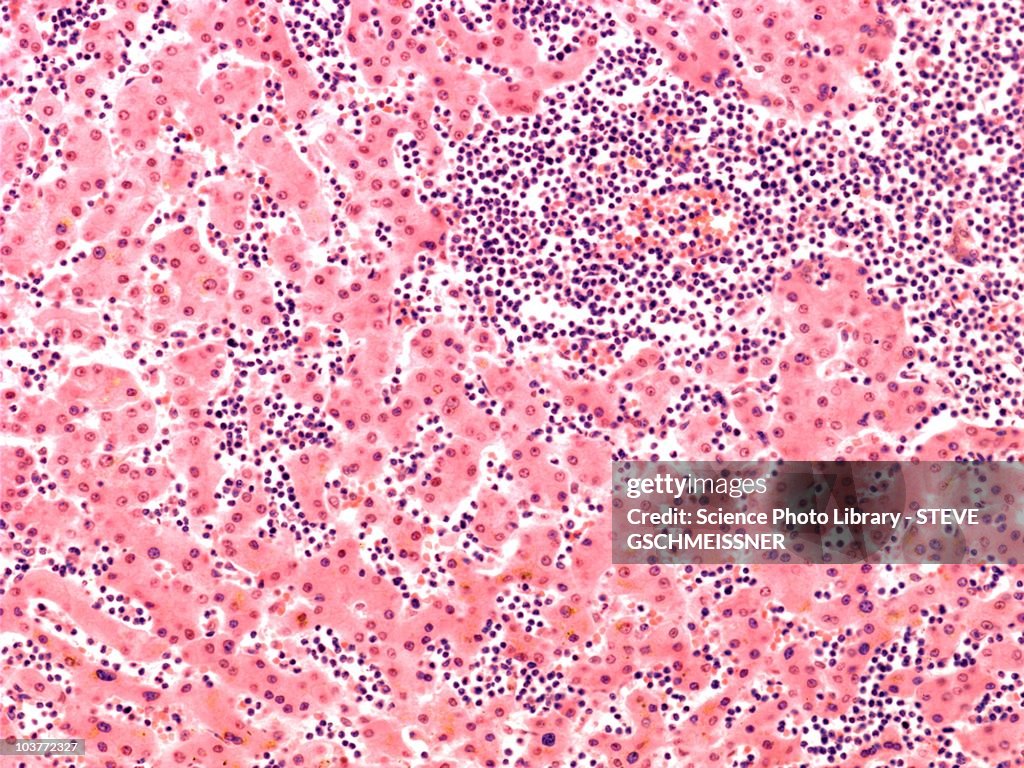 Leukaemia blood cells, light micrograph