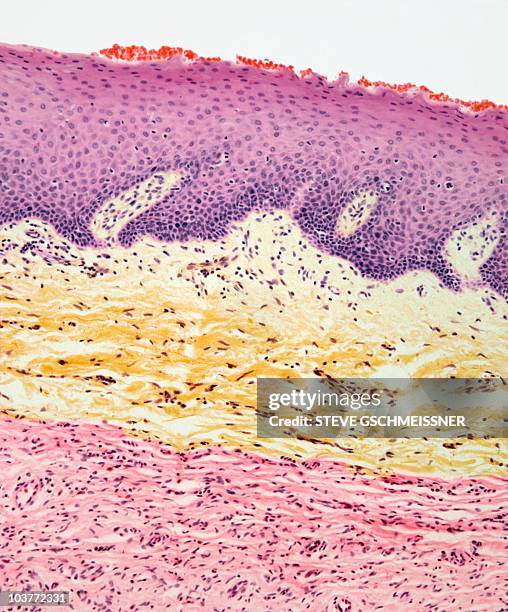 neurofibroma, light micrograph - neurofibroma stock pictures, royalty-free photos & images