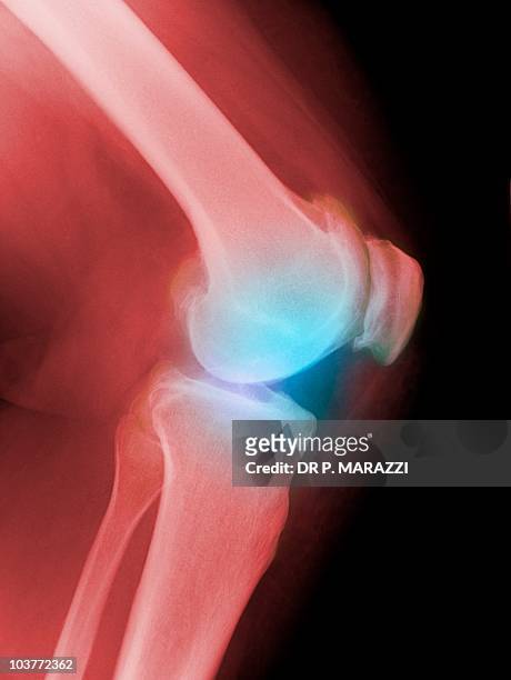 arthritic knee, x-ray - human knee 個照片及圖片檔