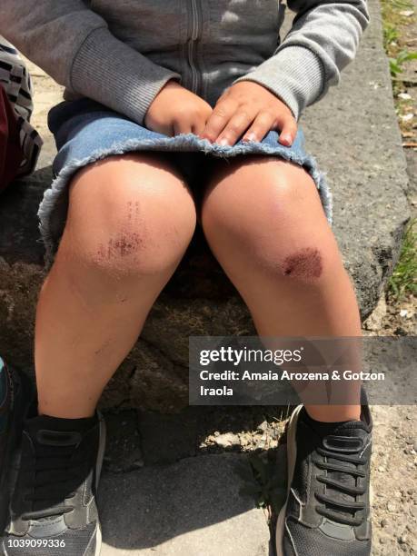 little girl with damaged knees. sicily, italy. - scraped knee stock pictures, royalty-free photos & images