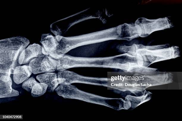 x-ray image of a human hand and wrist - wrist anatomy stock pictures, royalty-free photos & images