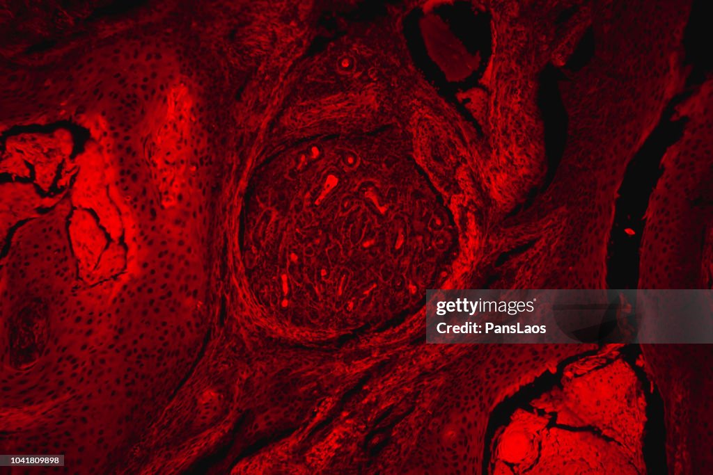 Red fluorescence micrograph of human skin cancer cell