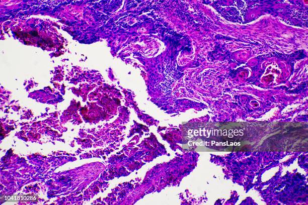 light micrograph of human skin cancer cell - person mikroskop stock-fotos und bilder