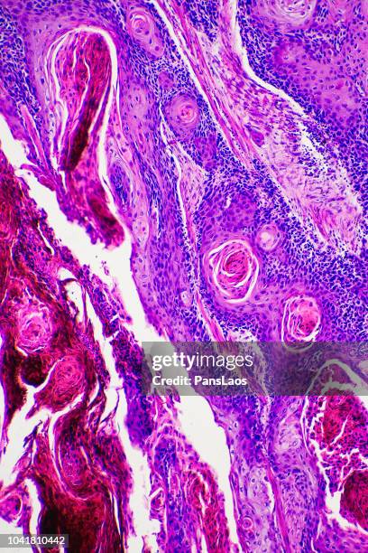 light micrograph of human skin cancer cell - histology 個照片及圖片檔