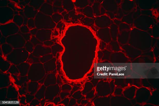 red fluorescence lipoma medical human tumour fatty tissue - cancer center stock-fotos und bilder