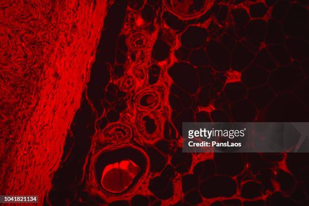 red fluorescence lipoma medical human tumour fatty tissue - lichtmikroskopische aufnahme stock-fotos und bilder