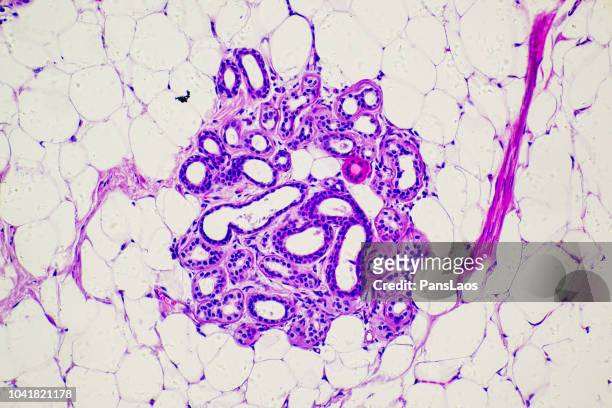 lipoma of human micrograph - fettgewebezelle stock-fotos und bilder