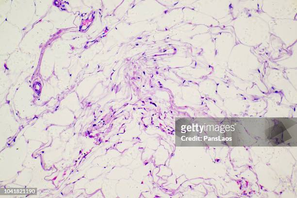 micograph of human tumour fatty tissue - adipose cell stock pictures, royalty-free photos & images