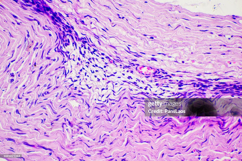 Medical of human tumour fatty tissue