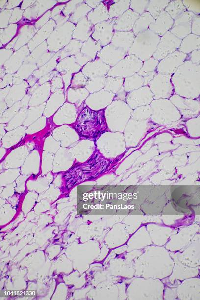 medical of human tumour fatty tissue - cirrhosis 個照片及圖片檔