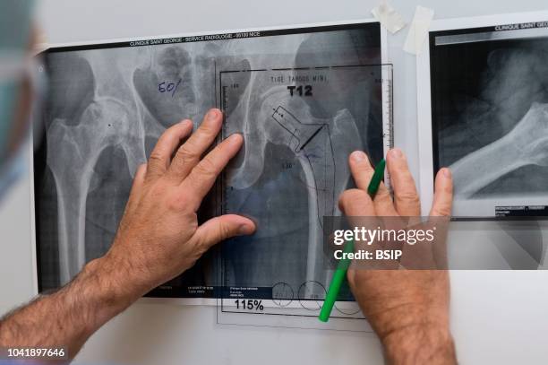 Orthopedic surgery, Saint George Clinic, Nice, France Fitting dual mobility hip prosthesis in patient suffering from osteonecrosis The surgeon plans...