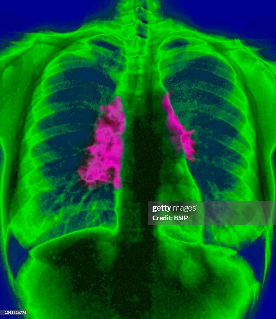 MEDIASTINAL ADENOPATHY