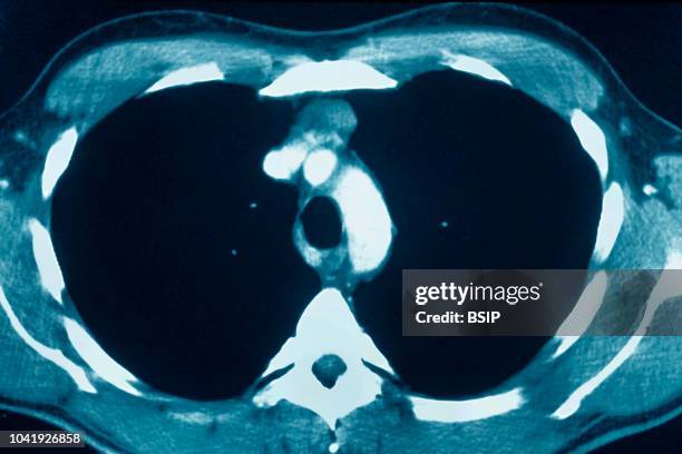 Thymus cancer seen on a cross-section chest CT scan.