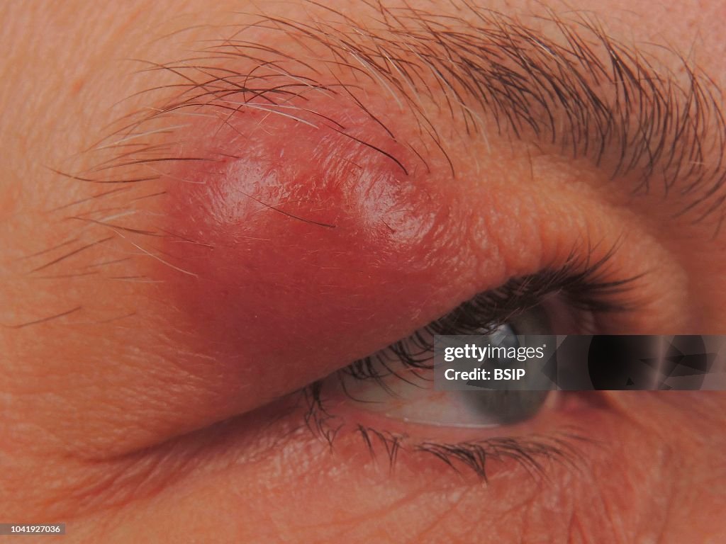 SEBACEOUS CYST