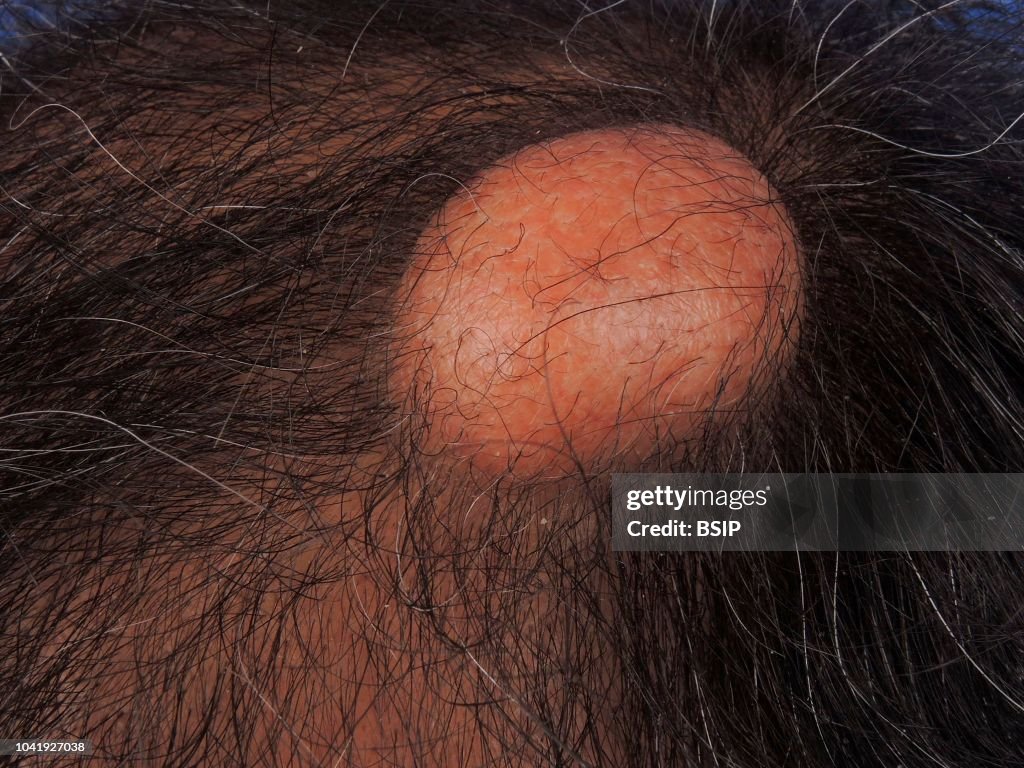 PILAR CYST