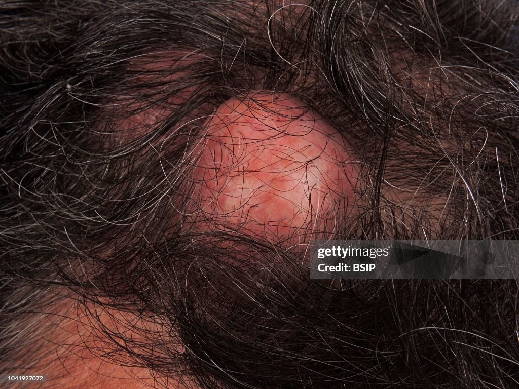 PILAR CYST