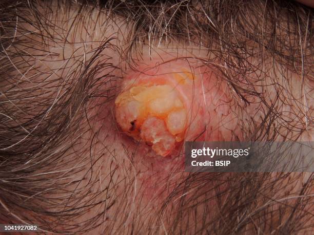 Fistulising cystic lesion of the scalp.