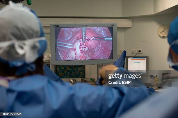 Gynecology surgery, Lenval Clinic, Nice, France Removal of an ovarian endometrium, endometriosis that forms a cyst in the ovary, by laparoscopy.