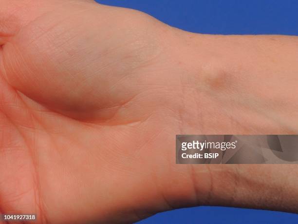 Synovial cyst of the wrist.