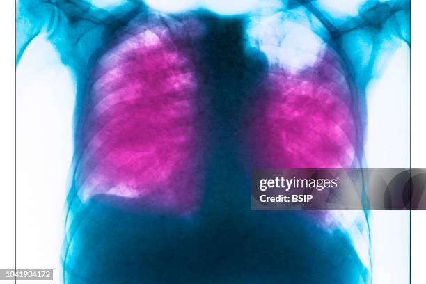 Allergic bronchopulmonary aspergillosis, ABPA, seen on a frontal chest x-ray.