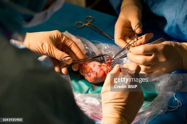 Kidney transplant in the urology, Nice, France, kidney is taken from a living related donor, the recipient's wife Analysis and preparation of the...