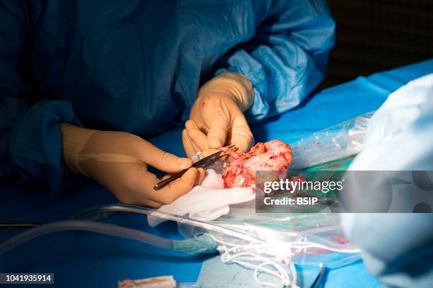 Kidney transplant in the urology, Nice, France, kidney is taken from a living related donor, the recipient's wife Analysis and preparation of the...