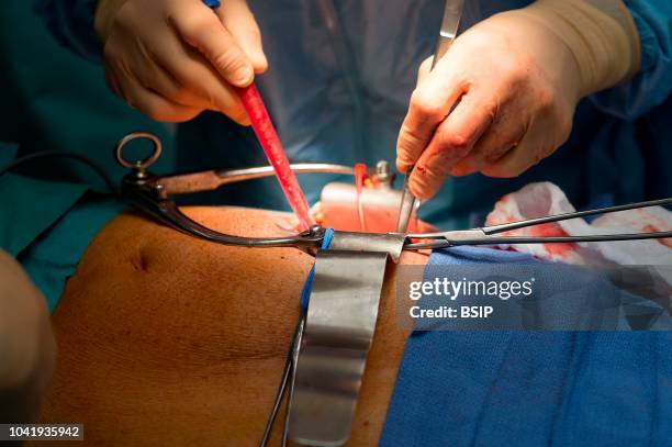 Kidney transplant in the urology, Nice, France, kidney is taken from a living related donor, the recipient's wife Transplanting the kidney in the...