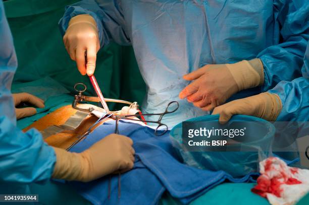 Kidney transplant in the urology, Nice, France, kidney is taken from a living related donor, the recipient's wife Transplanting the kidney in the...