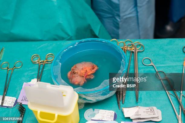 Kidney transplant in the urology, Nice, France, kidney is taken from a living related donor, the recipient's wife The donated organ ready to be...